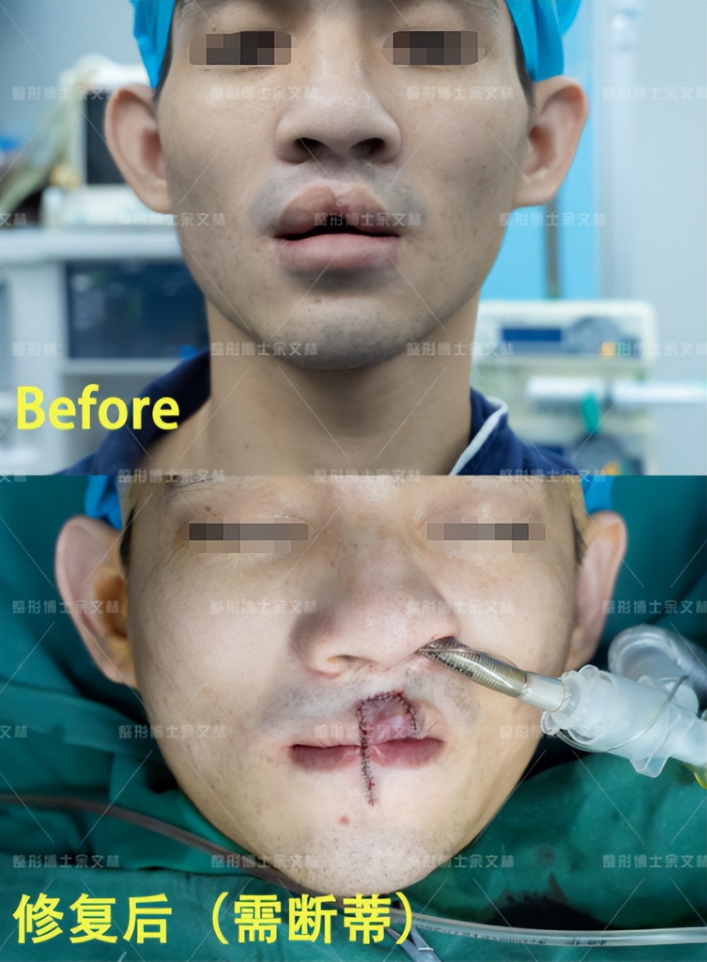 嘴巴缺了一小块肉多久能好,嘴巴好像缺了一块肉怎么回事