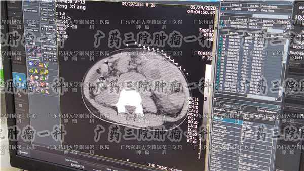 结肠癌腹腔积液严重吗,结肠癌患者有盆腔积液是转移吗