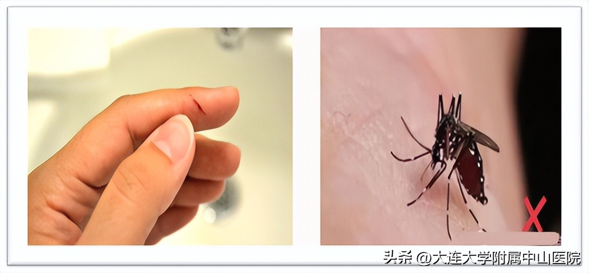 淋巴清扫后水肿怎么治疗可以康复,腋窝淋巴清扫后腋窝水肿处理方法