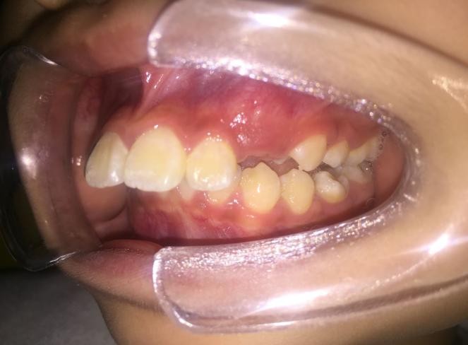 徐州儿童牙齿矫正牙齿不齐,大连口腔医院儿童牙齿矫正怎么样