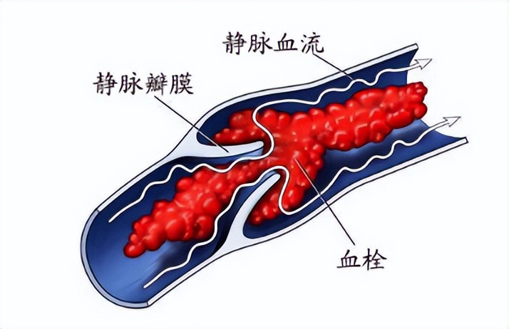 如何治疗静脉血栓,怎样治疗静脉血栓