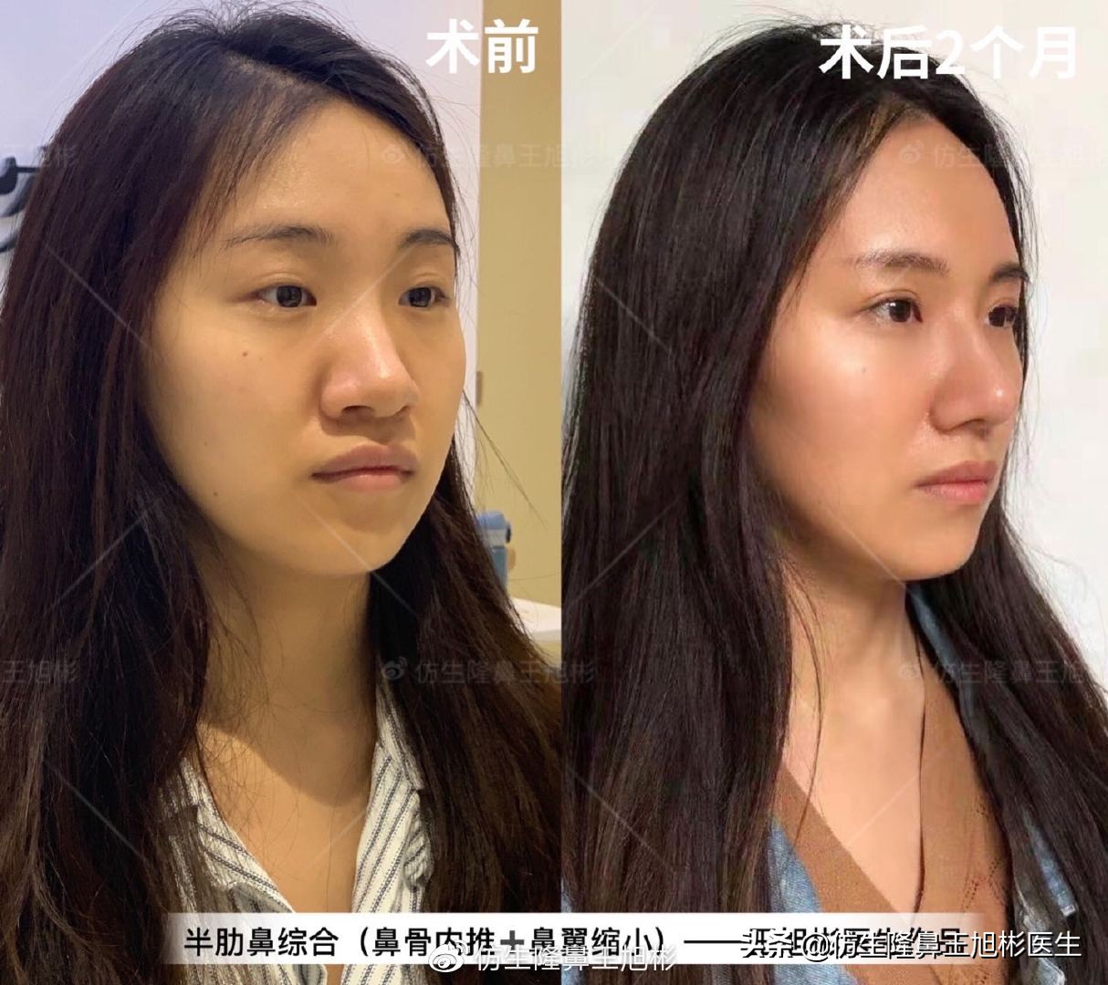 常见鼻部整形美容项目,整形鼻和自然鼻