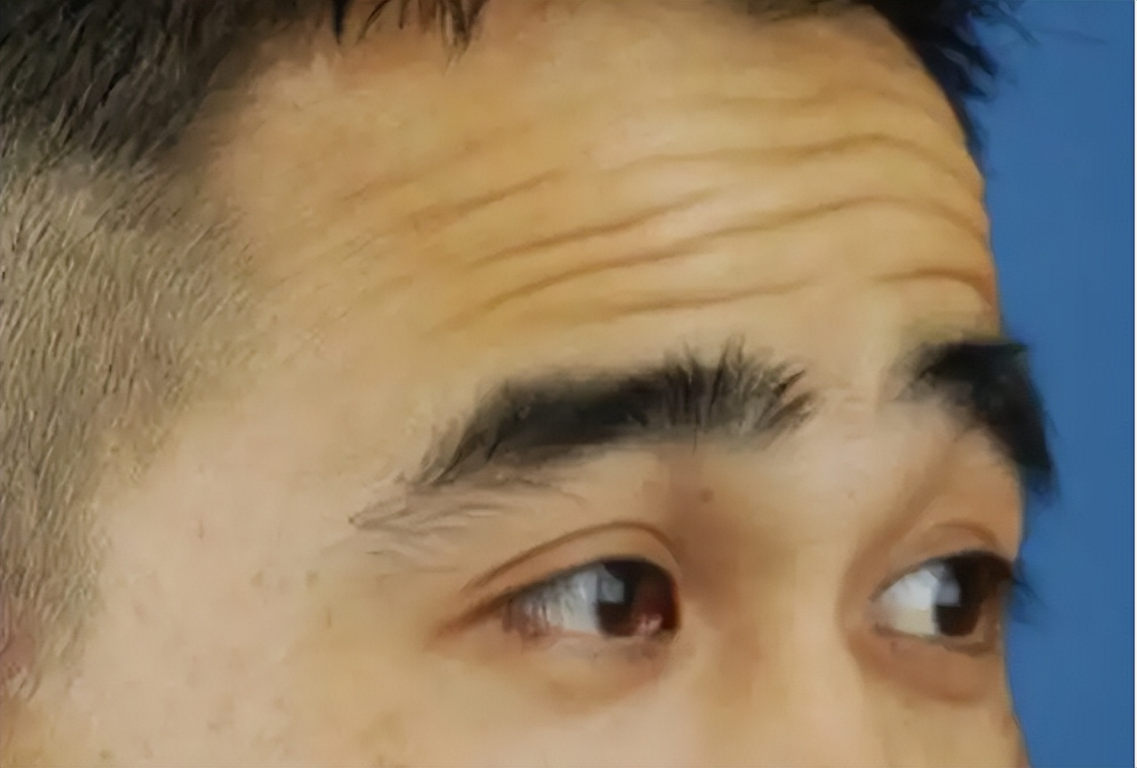 有效抗皱改善抬头纹,学生抬头纹怎么改善