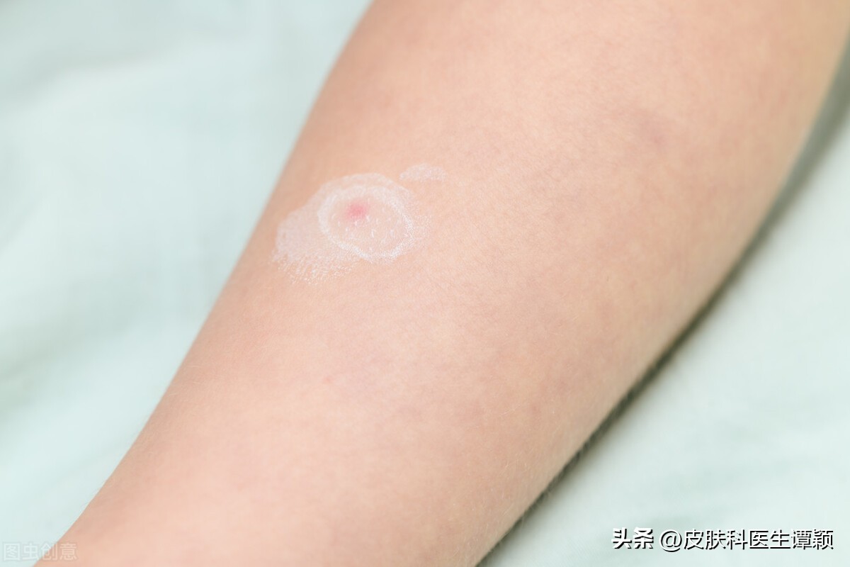 皮肤科医生和你聊聊：炉甘石洗剂可以治疗什么？有什么注意事项？