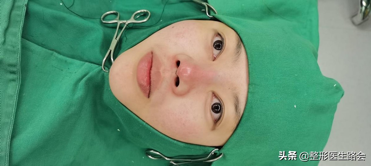 隆鼻失败鼻头有个坑的原因,隆鼻失败导致的鼻头凹陷怎么修复