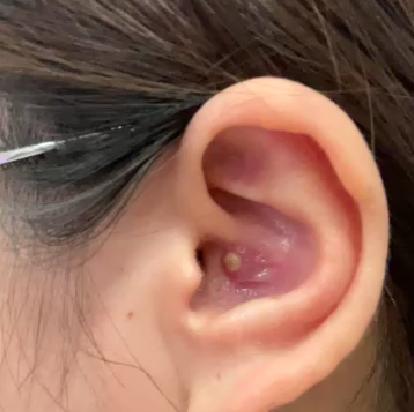 外耳道疖肿的症状和治疗方法,外耳道疖肿的治疗方法有哪些