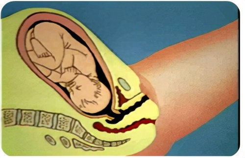 孕妈妈怎么判断胎位是正的,胎儿屁股在右侧是什么胎位