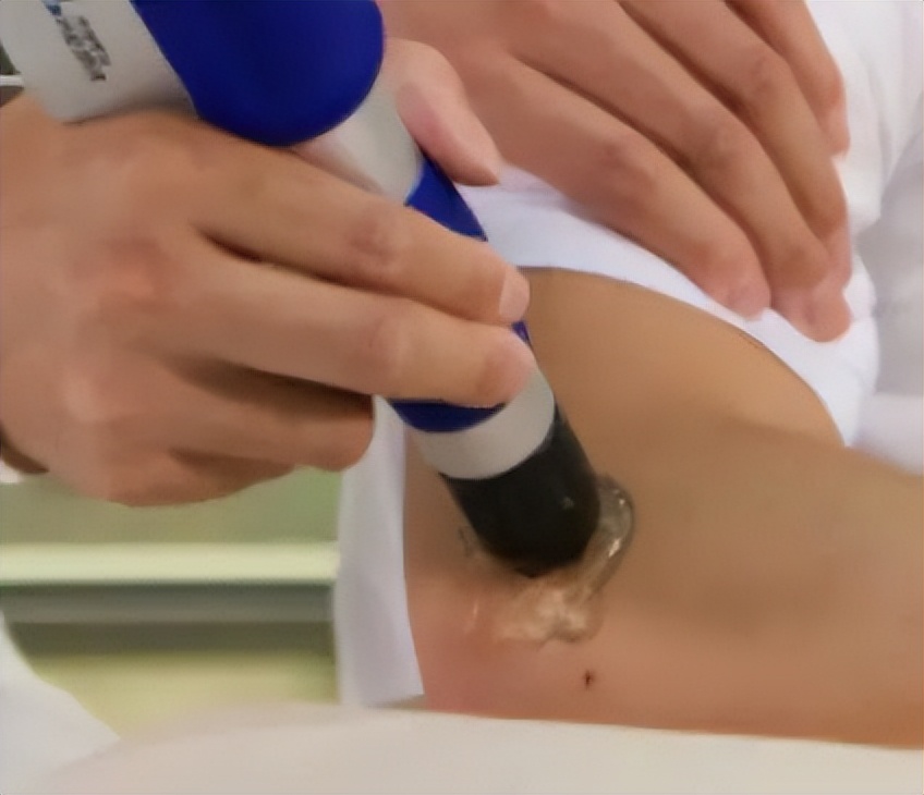 在做冲击波治疗前可以打封闭吗,冲击波治疗网球肘有效吗