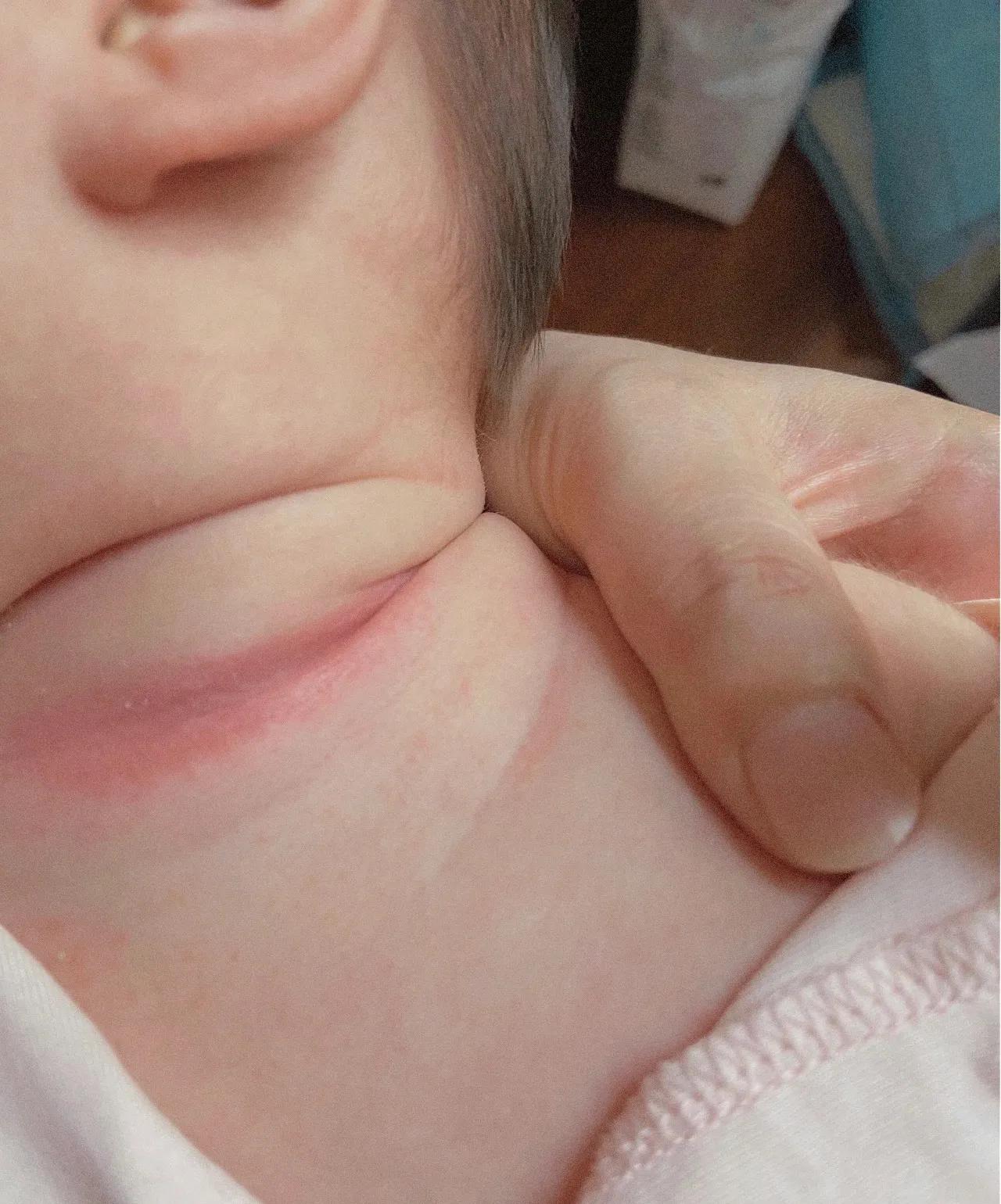 新生儿淹脖子发红怎么处理,宝宝淹脖子泛红涂什么最好