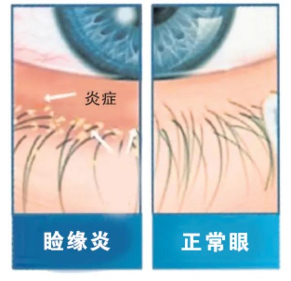 眼痒疼怎么治疗,眼痒痛模糊怎么回事