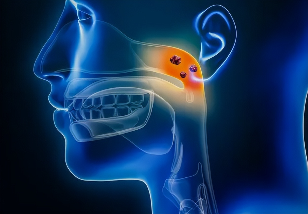 早期鼻咽癌能生存多少年,鼻咽癌早期生存率