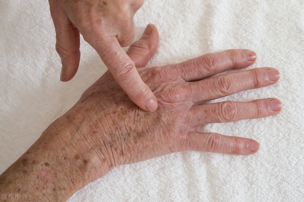 老年斑怎么去掉有什么办法,年轻人怎样预防以后老了有老年斑