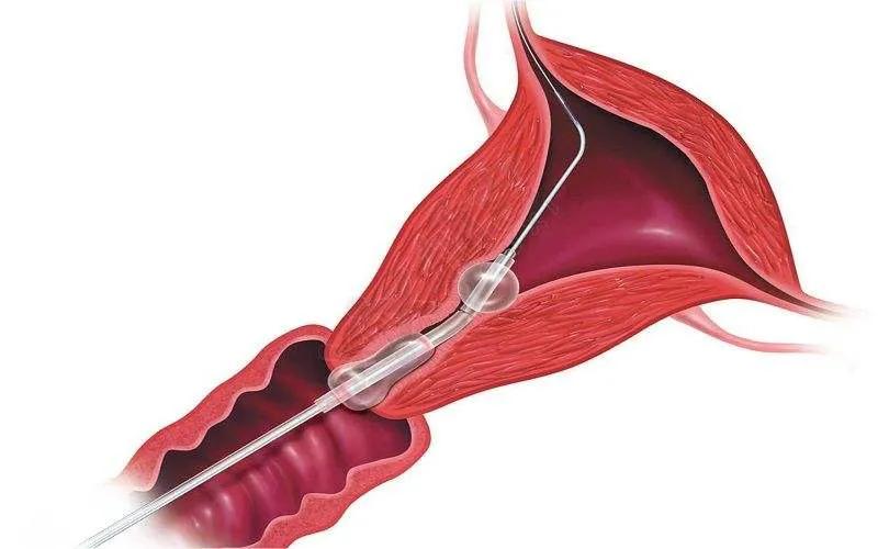 妇产科病房的真实故事,关于妇科手术室的故事