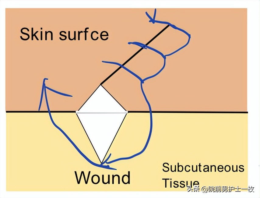 关于急诊清创缝合术必须掌握知识