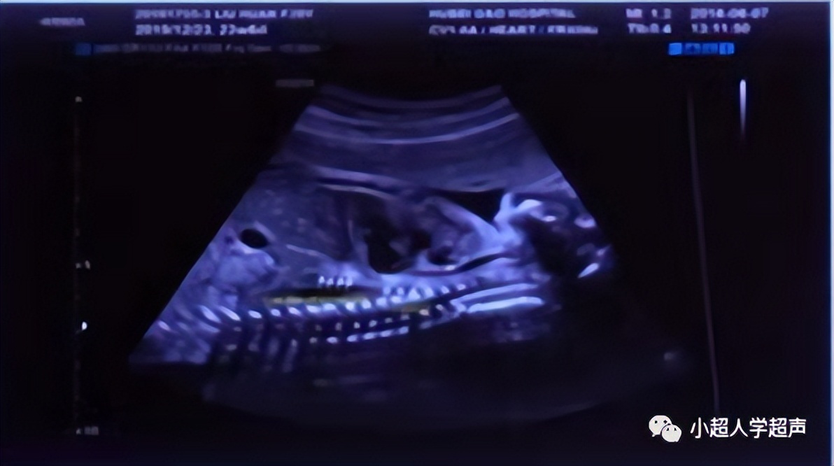 超声影像小视频,食道闭锁超声表现