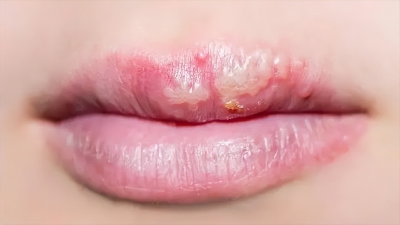 嘴上出了好多透明水泡会传染吗,嘴上起水泡是什么原因传染吗