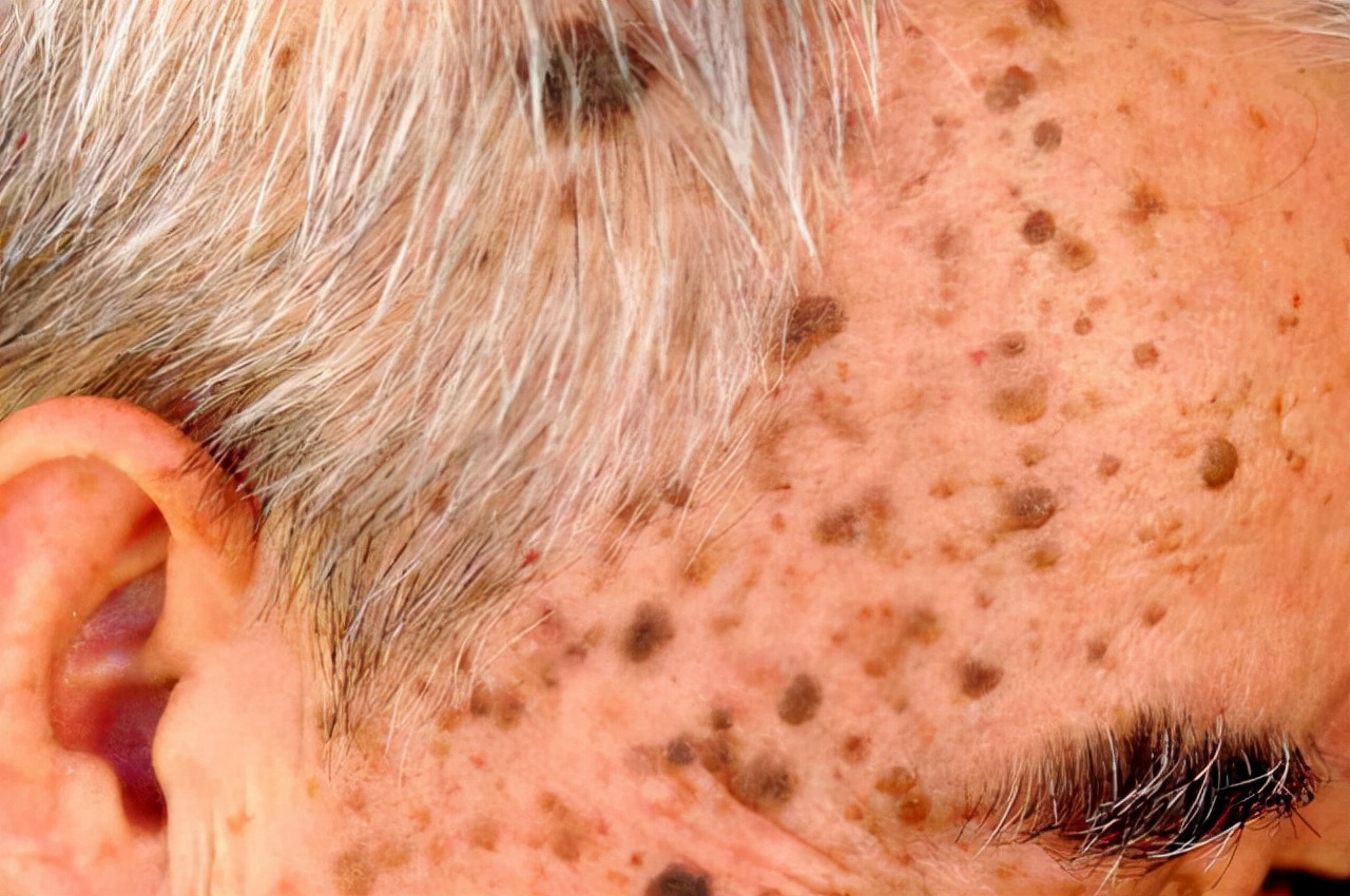 红霉素软膏去老年斑小妙招,红霉素软膏真的能祛除老年斑吗