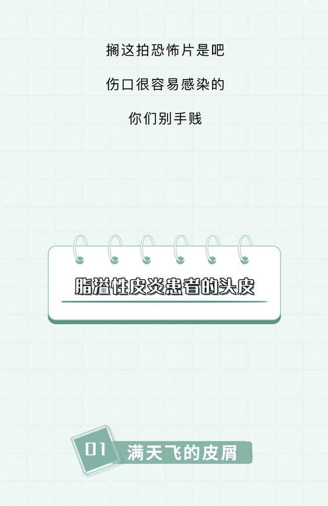 头皮上的白色颗粒,头皮上的白色颗粒是虱子吗