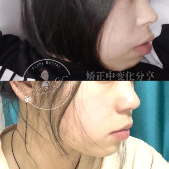 不拔牙矫正嘴凸下巴后缩案例,嘴瘪不拔牙矫正嘴会凸怎么办