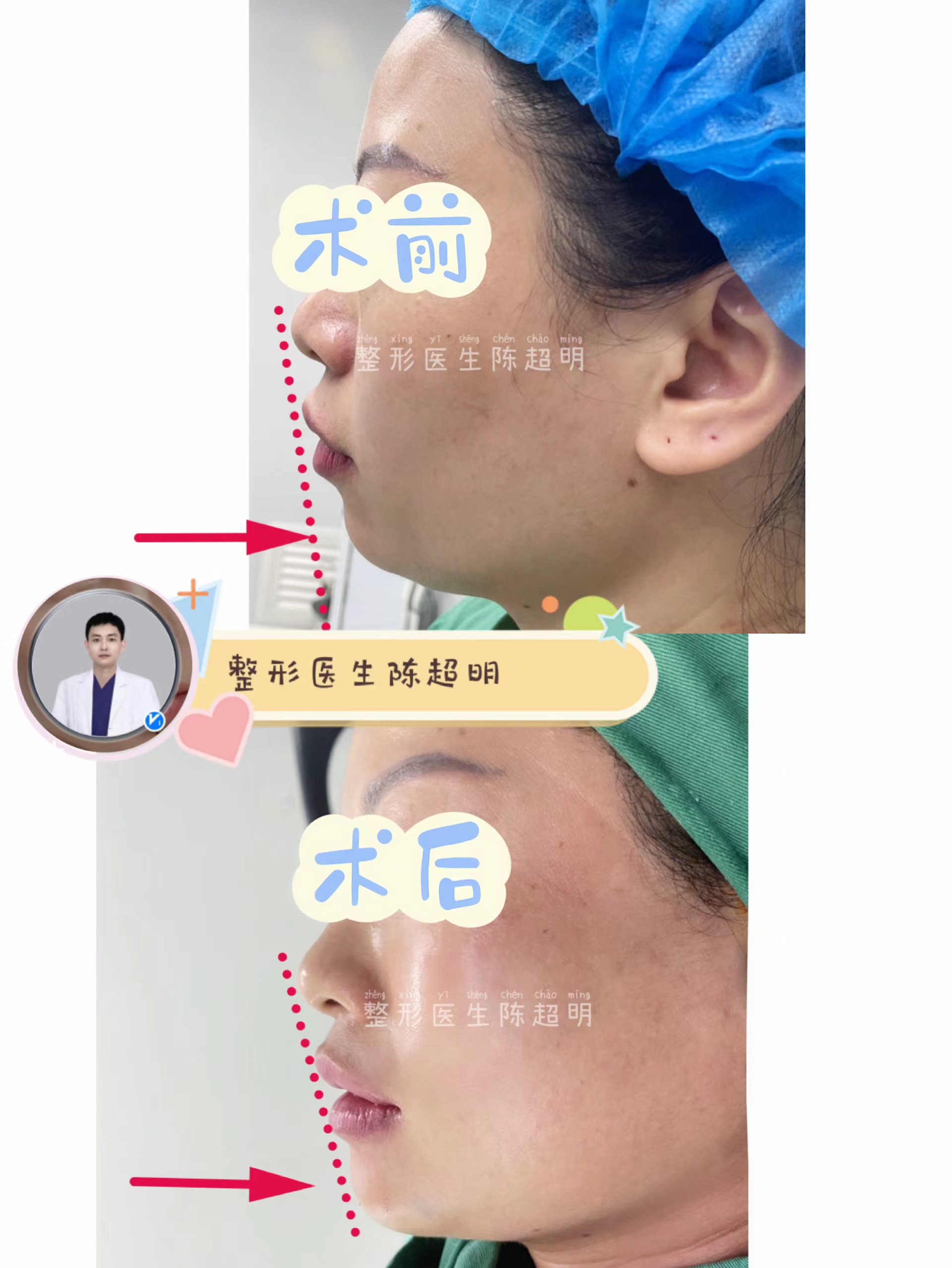 侧颜下巴后缩,明星下巴后缩侧颜