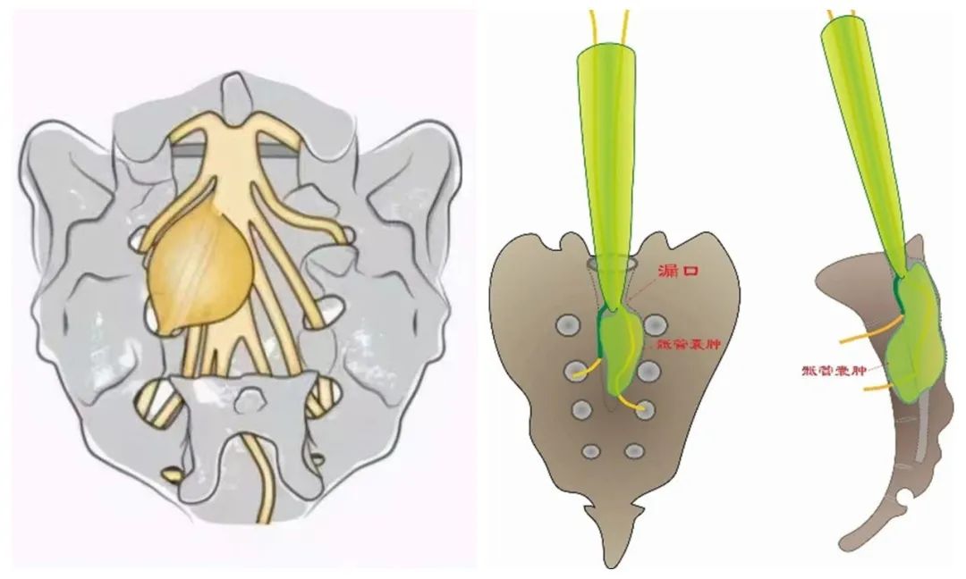 骶管囊肿是肿瘤吗？我该怎么办？