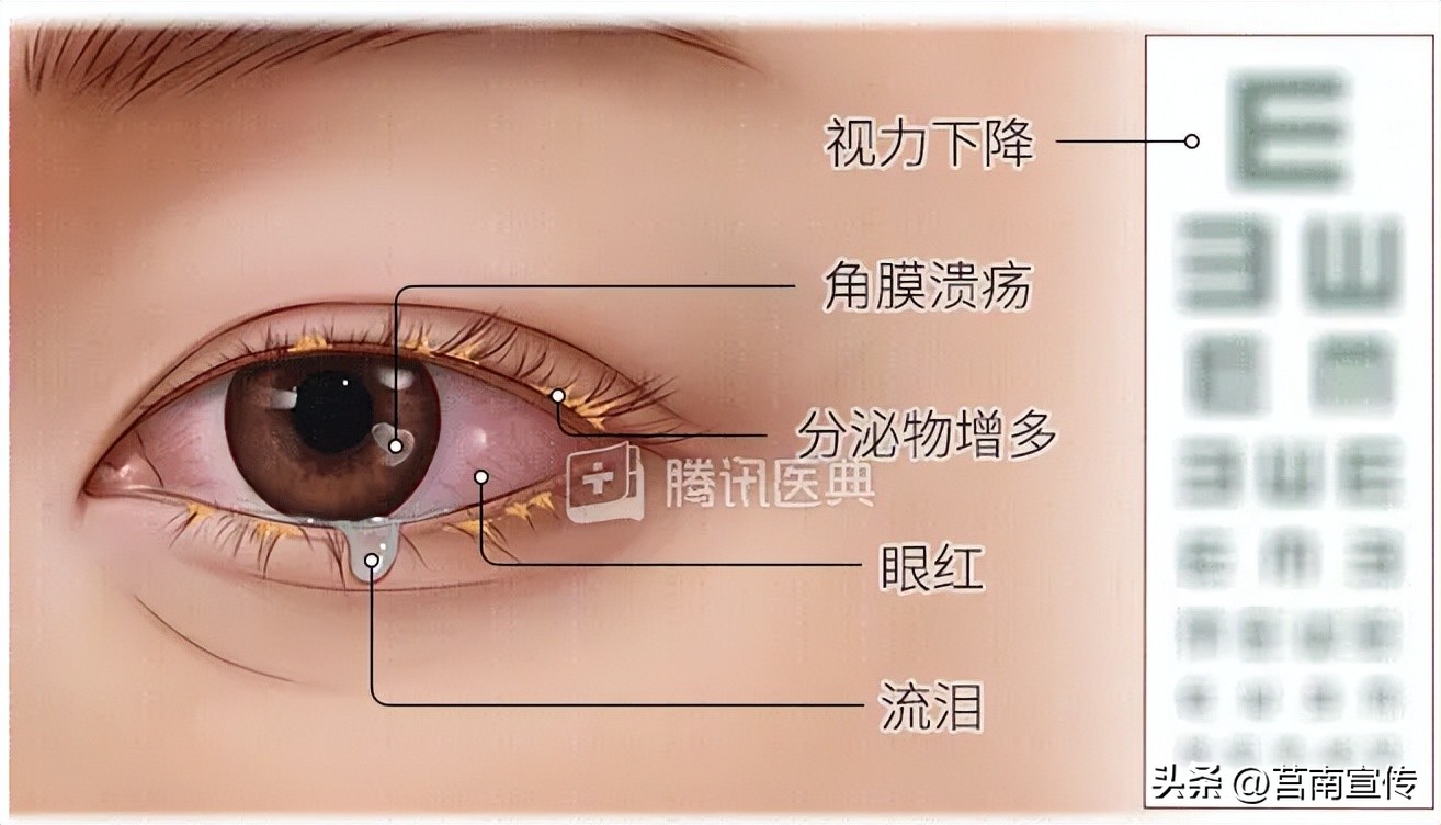 眼睫毛倒长有什么解决办法,睫毛倒长扎眼睛怎么处理