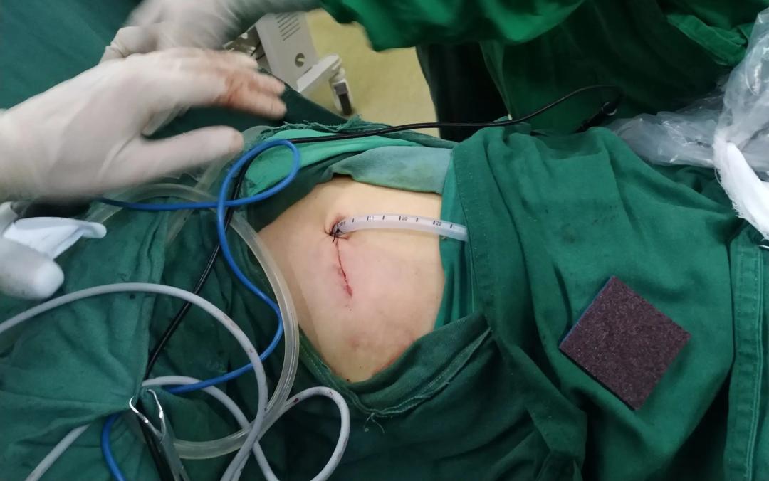 全球首个肺癌免疫新辅助方案,治疗肺癌的机器