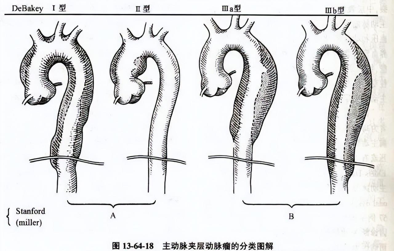 突发主动脉夹层破裂抢救无效去世,急性主动脉夹层经24天没醒死亡