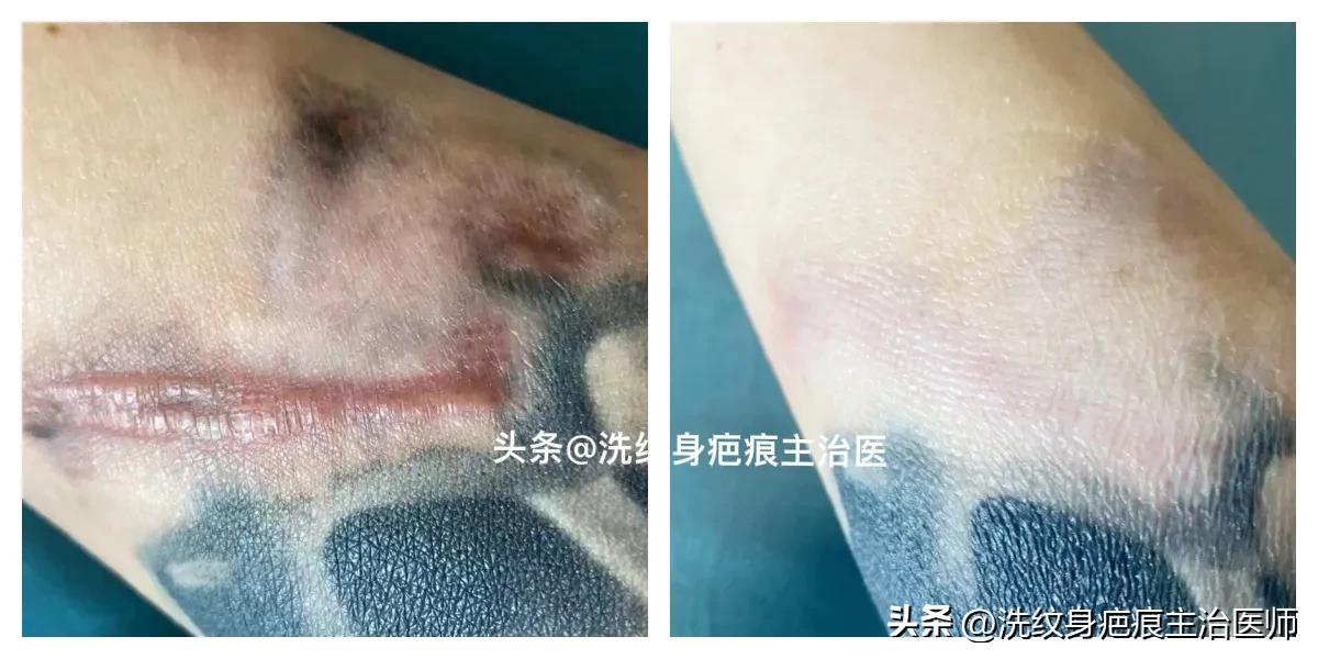 眼袋手术疤痕增生怎么办,剖腹产疤痕增生怎么办