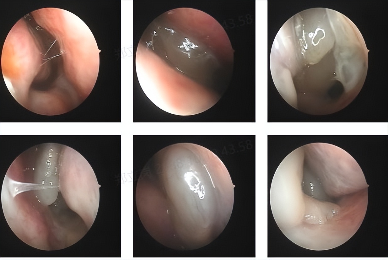嗜酸性粒细胞性鼻息肉容易复发吗,鼻息肉手术后6个月复发怎么处理