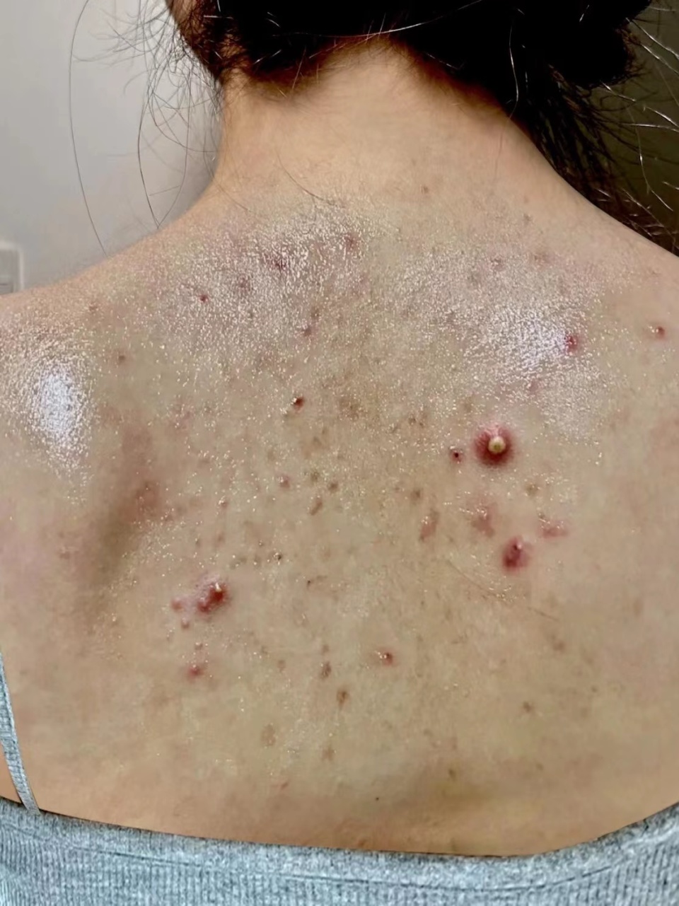 沐浴露祛痘除螨真的有效吗,后背祛痘除螨去鸡皮沐浴露推荐