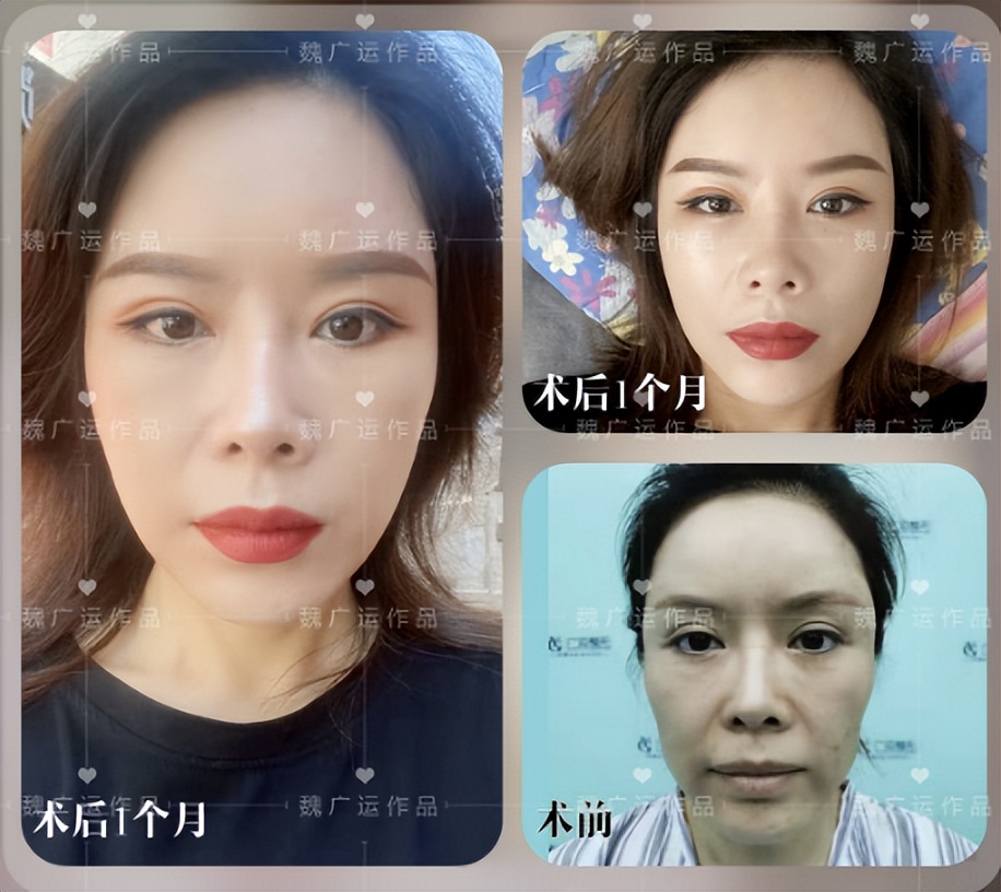 全脸拉皮手术前后6天的效果,拉皮手术多长时间能全部消肿