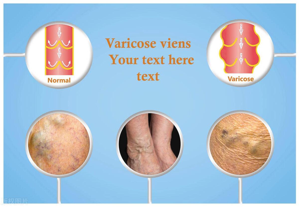 夏季湿疹高发中医调理如何显奇效,夏季炎热湿疹犯了咋办