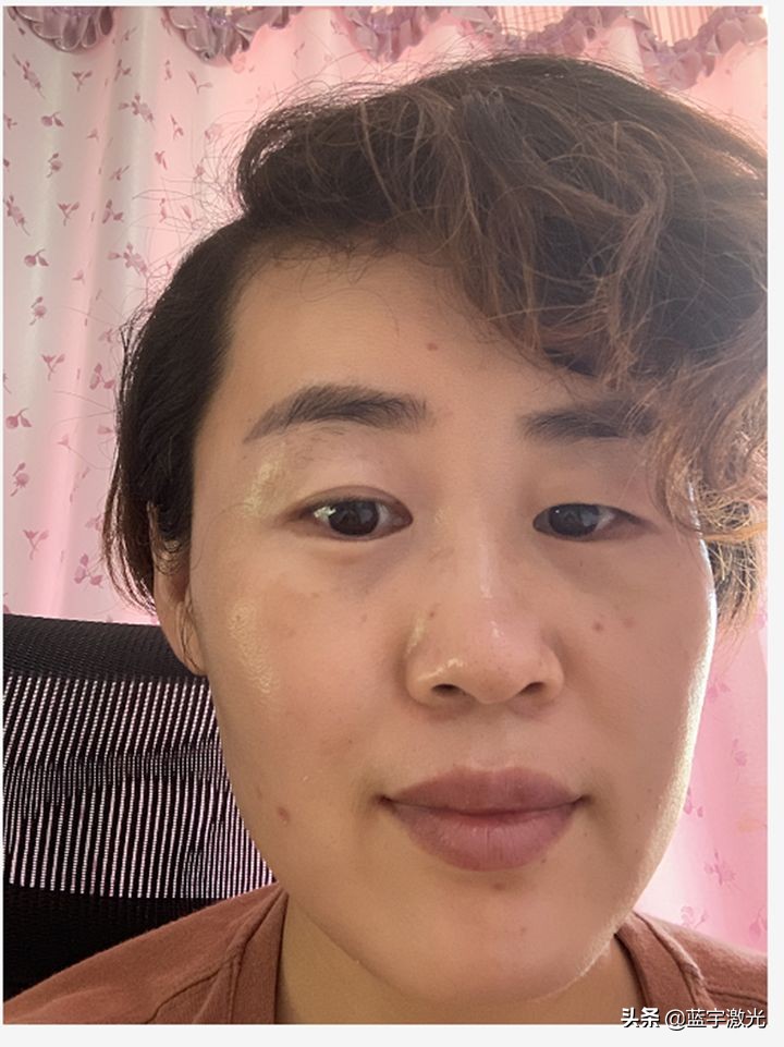 激光美白可以达到全身美白嘛,天生黑激光美白亲身经历