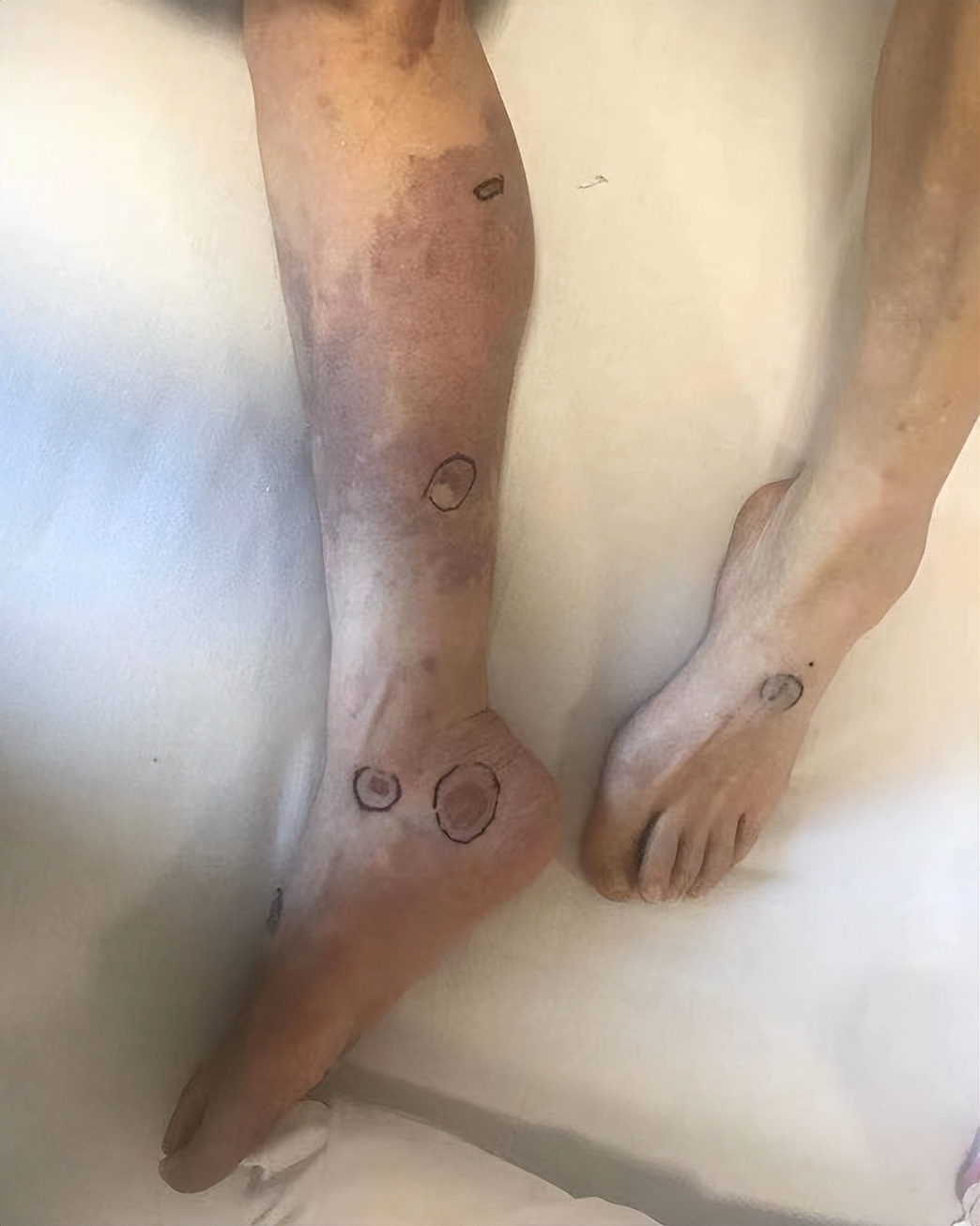 心房颤动3次引发血栓，八旬老人下肢坏疽，无奈截肢保命