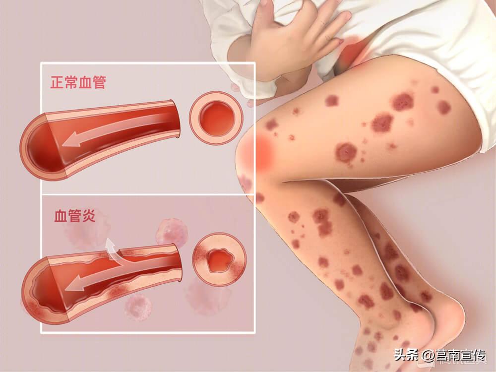 身上长这几个小红点是癌症,身上长了红点看什么科