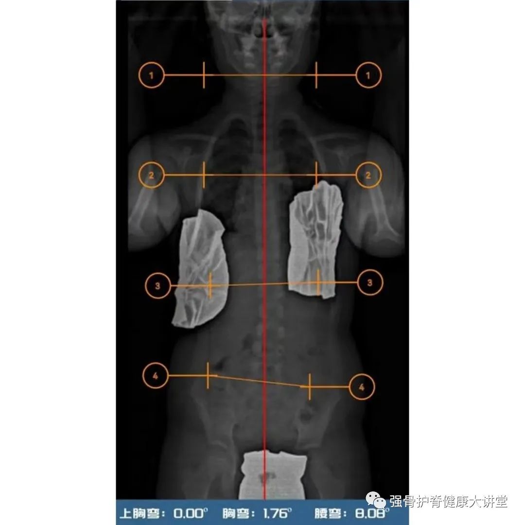 儿童脊柱侧弯治疗图,儿童脊柱侧弯最佳治疗方法
