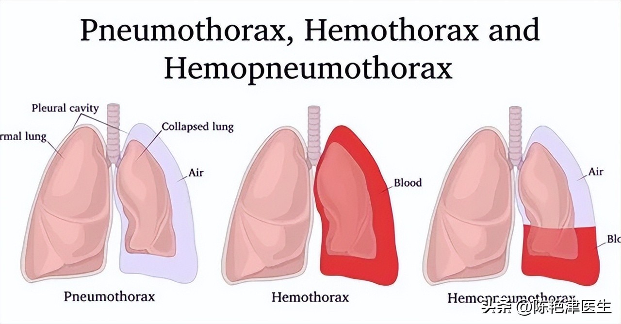 为什么医生不肯说肺大泡有多大,体检肺大疱是什么意思