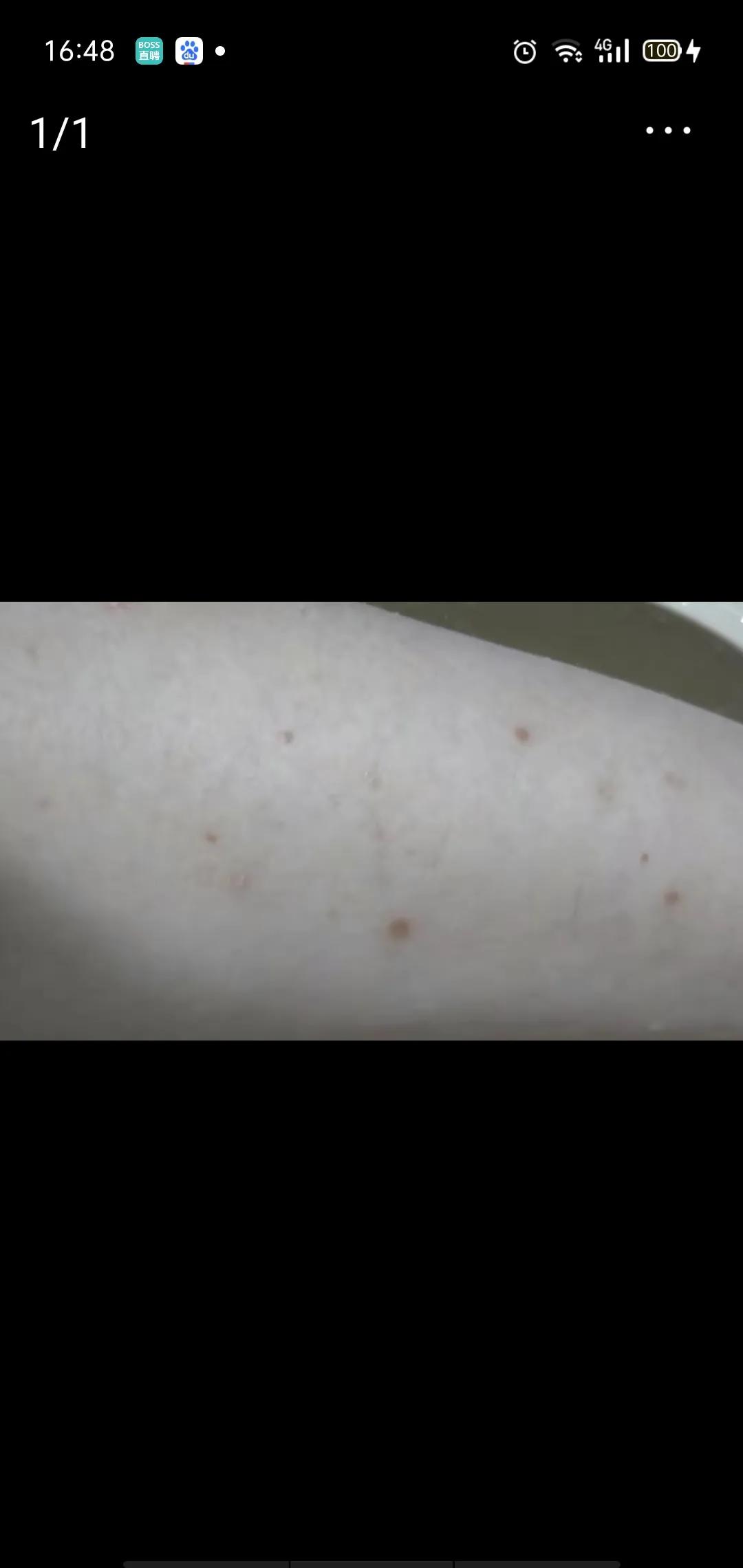 银屑病患者治病历程,银屑病寿命一览表