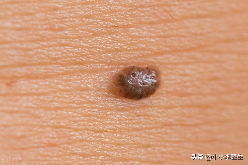 激光祛痣笔真的有用吗,冷冻祛痣好还是激光好