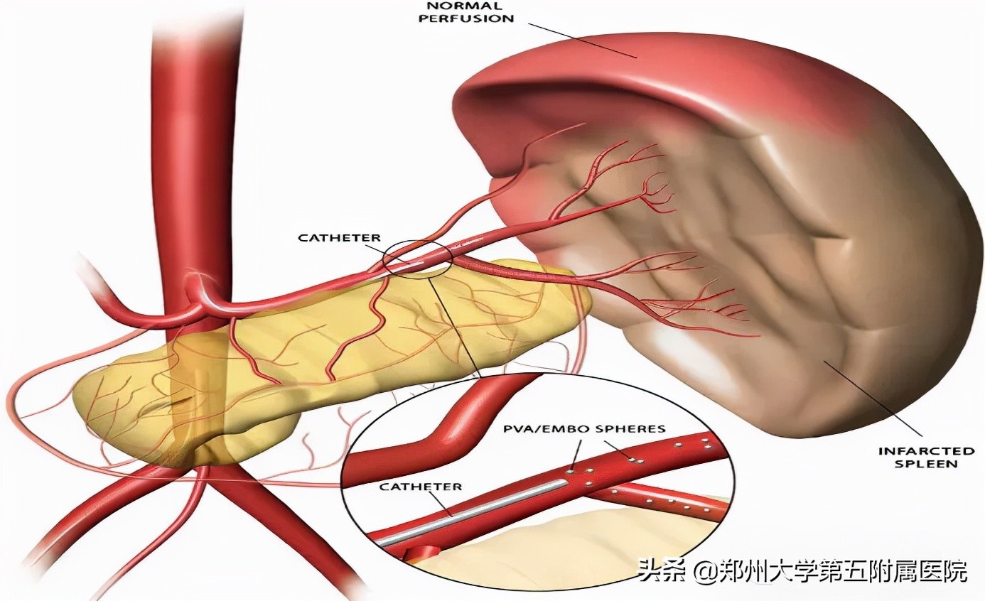 食管胃底静脉曲张破裂二次出血,胃底静脉曲张破裂出血致死