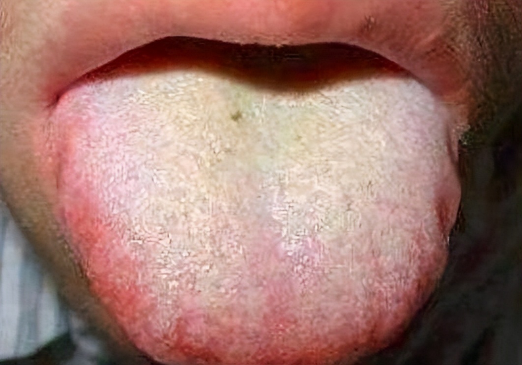 有气血虚一吃补气血的就上火,气血不足吃完补气血药上火怎么办