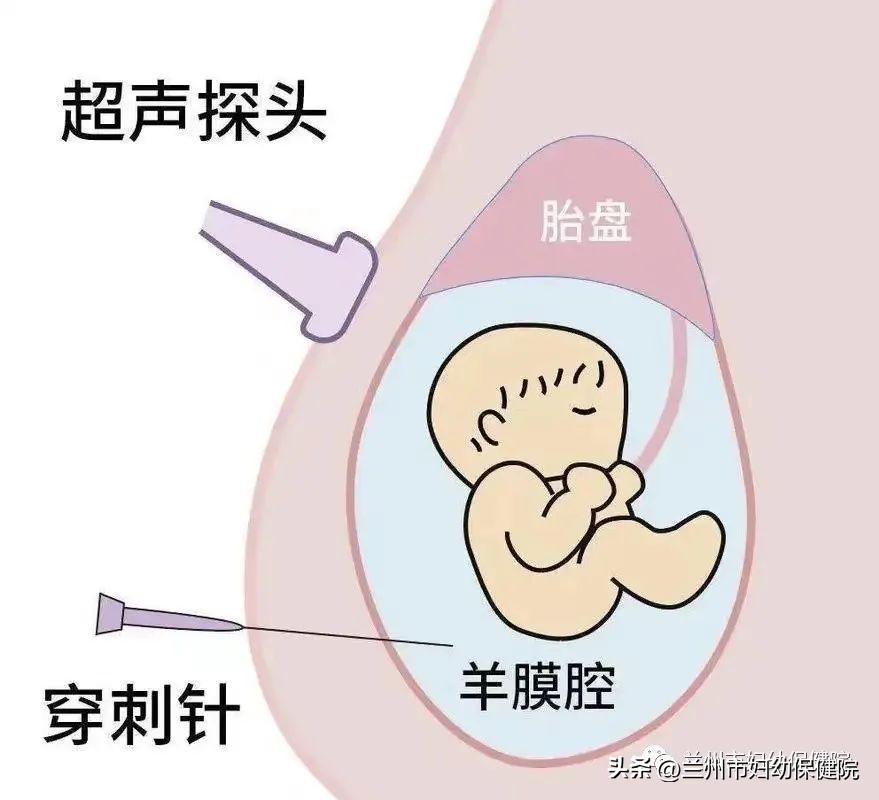科普羊水穿刺你了解多少,科普羊水多的视频