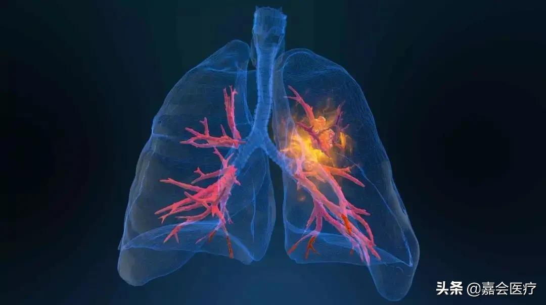 肺癌15项基因检测,肺癌15年后应注意什么