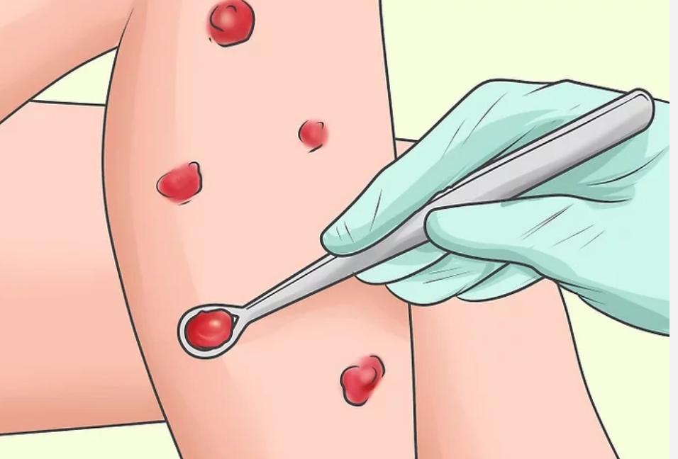 为什么小孩有那么多痘痘,儿童痘痘的最佳治疗方法