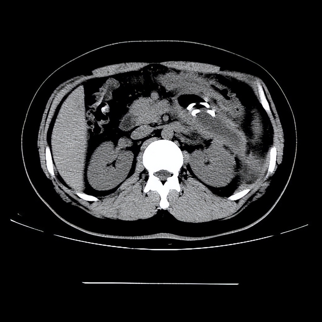 形成囊肿了该怎么把囊肿消下去呢,医生提醒大多数囊肿无需处理