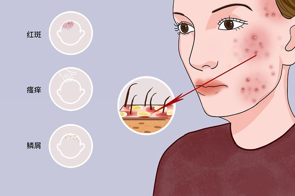 头皮上总出油长有疙瘩或脓包,头皮有疙瘩脓包痒痒用什么药