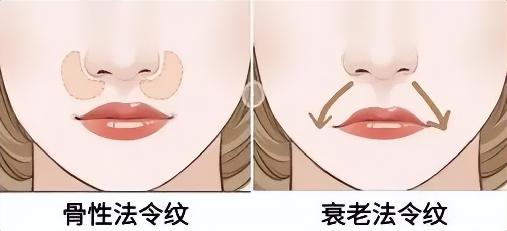 遗传的法令纹特别显老怎么办,眼睛泪沟和法令纹显老怎么办