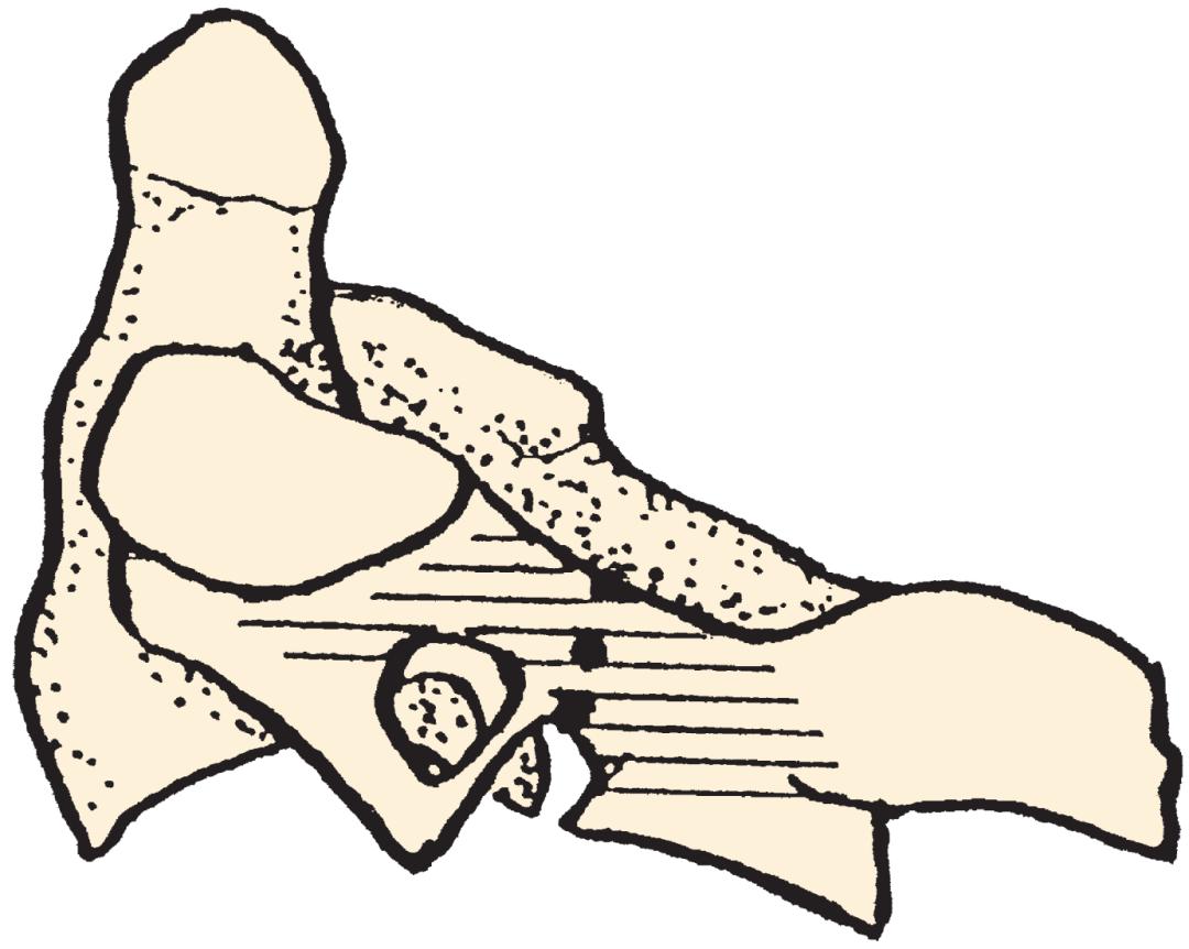 轻度峡部裂和重度峡部裂的区别,真性峡部裂和假性峡部裂