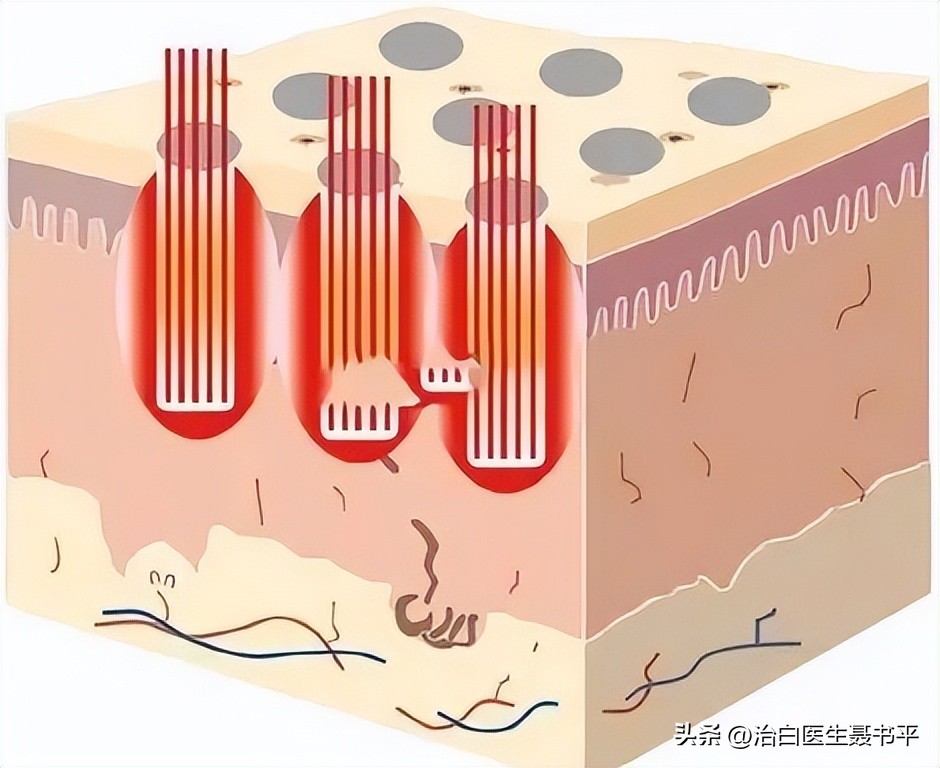 点阵激光疗法，打破白癜风治疗瓶颈